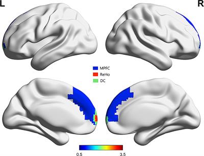 Altered regional neural activity and functional connectivity in patients with non-communicating hydrocephalus: a resting-state functional magnetic resonance imaging study